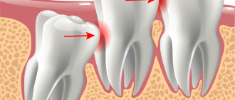 После удаления зуба болит челюсть: почему и сколько болит челюсть после удаления коренного и зуба мудрости