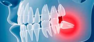 Болят зубы после удаления зуба мудрости: последствия и способы лечения