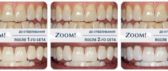 Отбеливание зубов Zoom 3: цена, отзывы, как проходит процедура